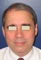 Hair Transplant