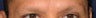 Eyebrow Transplant