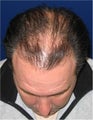 Hair transplant