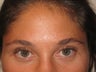 Eyebrow transplant
