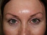 Eyebrow transplant 