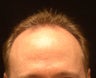Male Hair Transplant