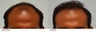 Hair Transplant 