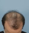 Hair Transplant