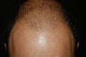 hair transplantation using Neograft