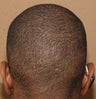 FUE hair transplant Neograft in  African American - donor site