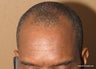 Neograft FUE hair transplant in African American