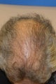 Hair Transplant
