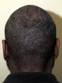 FUE hair transplant African American  donor site