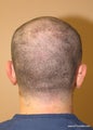 FUE hair transplant donor site - no scar technique