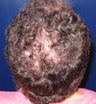 Hair Transplant 