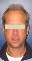 Hair Transplant 