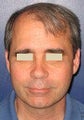 Hair Transplant