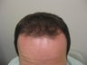 Hair Transplant
