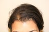 Hair Transplantation