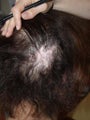 Hair Transplant to Prior Scar