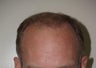 Hair Transplant 2000 grafts