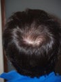 Hair Transplant 