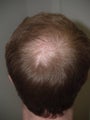 Hair Transplant 