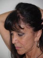 Hair Transplant into Scar