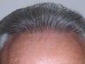 Hair Transplant