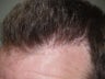 Reparative Hair Transplant