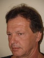Hair Transplant