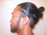 Facial Hair Transplant