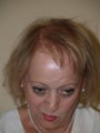 Hair Transplant