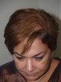 Hair Transplant