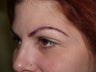 Eyebrow Transplants