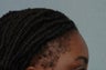 Hair Transplantation