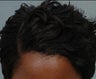FUE Hair Transplantation