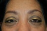 neograft brow transplant procedure