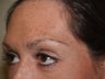 Eyebrow Transplant