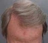Hair Transplant
