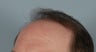 Hair Transplant