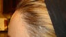 Surgical Hairline Advancement
