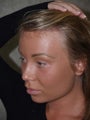 Before and After Surgical Hairline Advancement
