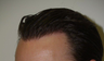 Hair Transplant