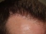 Reparative Hair Transplant