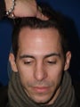 Hair Transplant FUE 