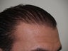 Hair Transplant (FUM)