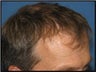 Hair Transplant