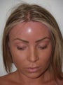 Surgical Hairline Advancement Procedure