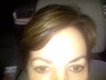 Eyebrow Transplant Procedure