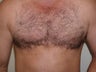 Hair Transplant Procedure