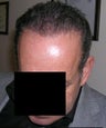 Hair  Transplantation with power FUE Technique