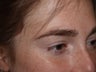 Before and After Eyebrow Hair Transplant