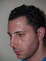 Before and After Rhinoplasty and Hair Transplant Procedures